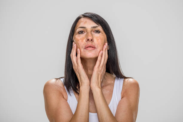 Portrait of beautiful Caucasian senior woman with skin problems Vitiligo. She is posing in studio on white background, with serious facial expression. Skin disorder, health and illness