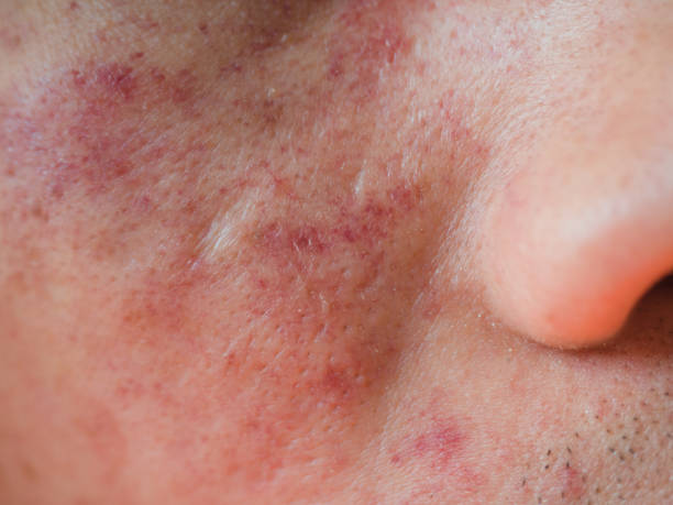 Allergic dermatitis skin caused by seafood food poisoning