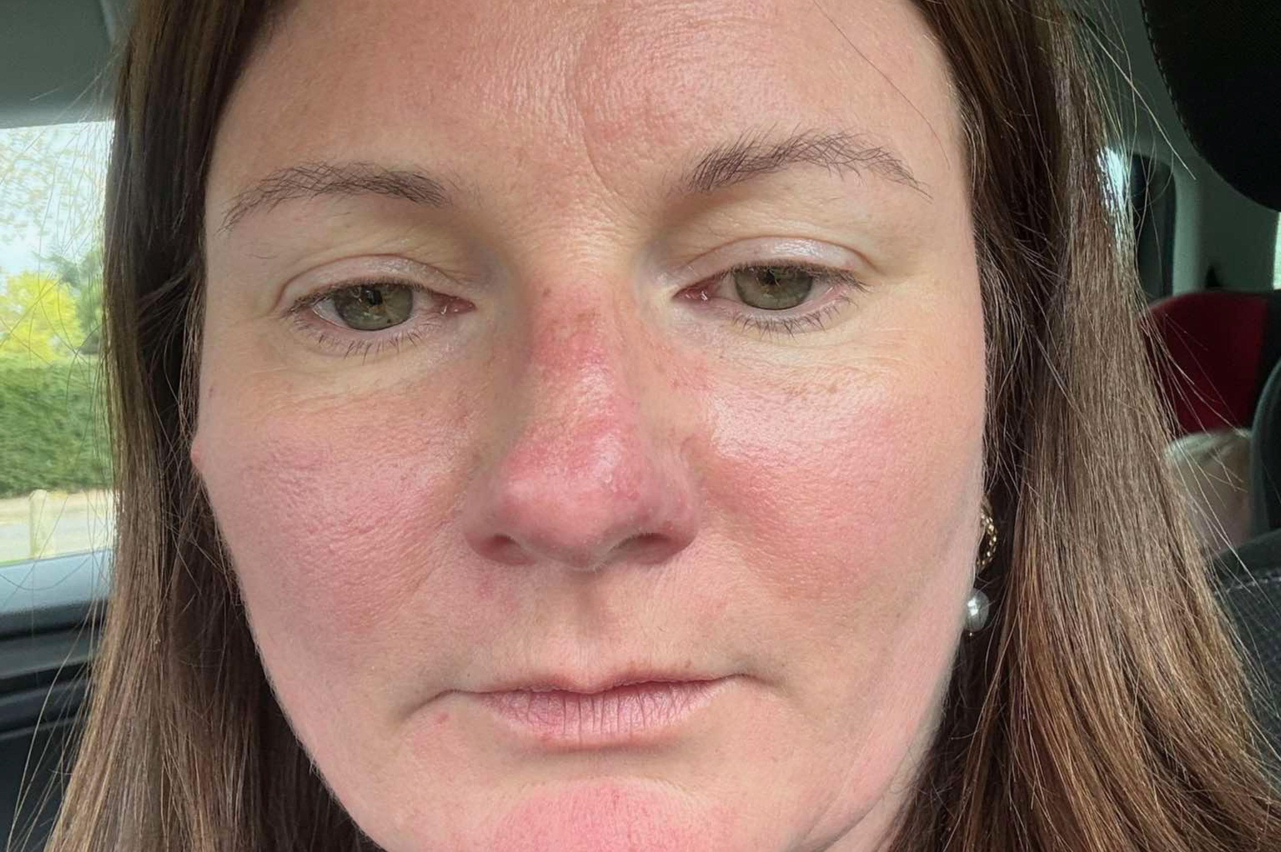 ROSACEA AFTER