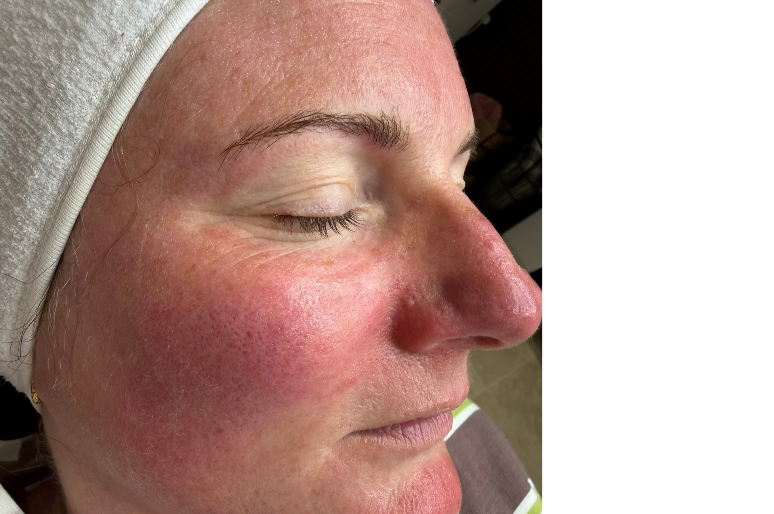 ROSACEA BEFORE (1)