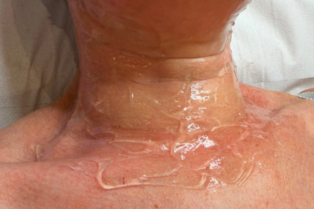 Radio frequency skin tightening