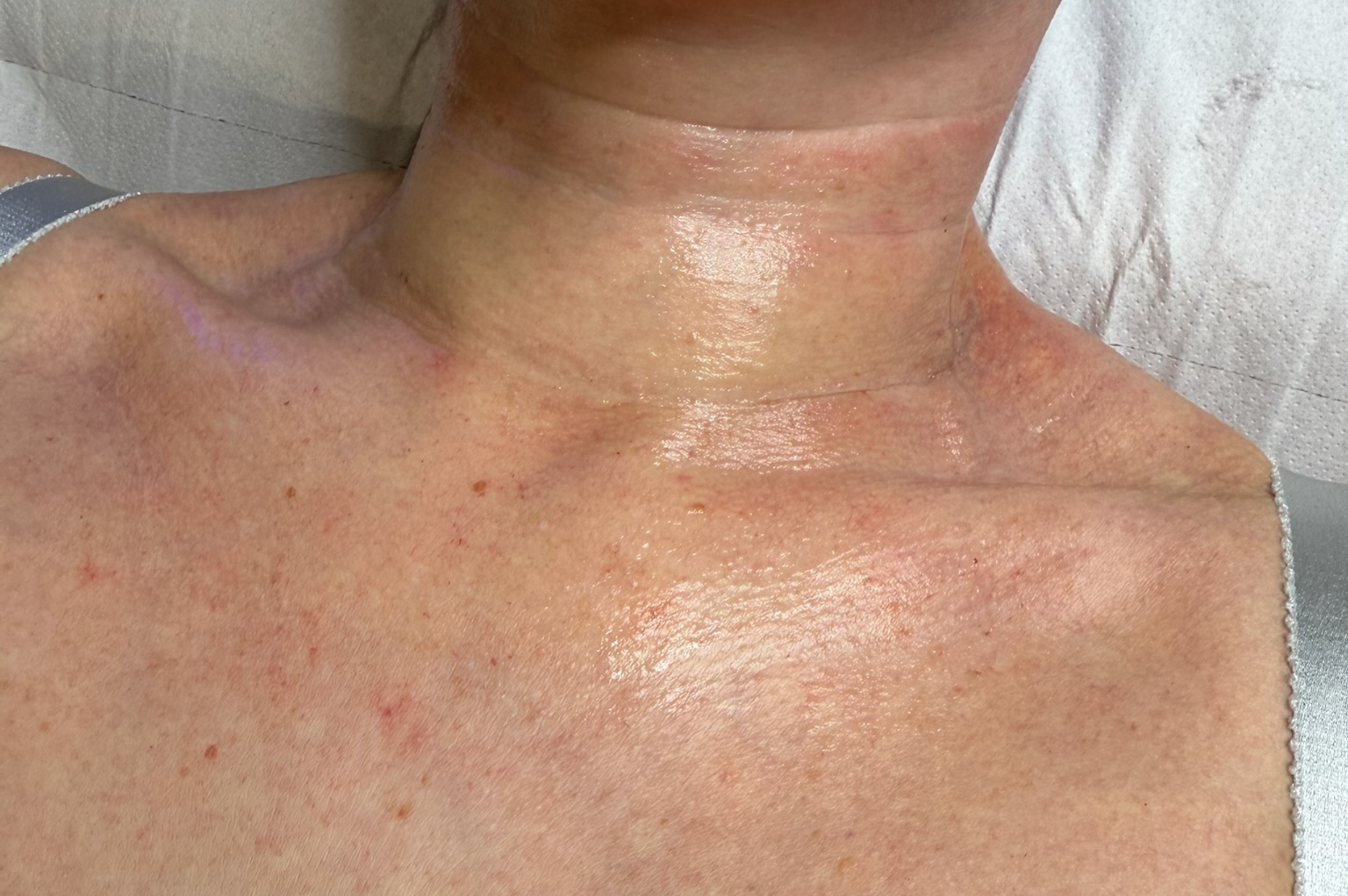 SKIN TIGHTENTING AFTER