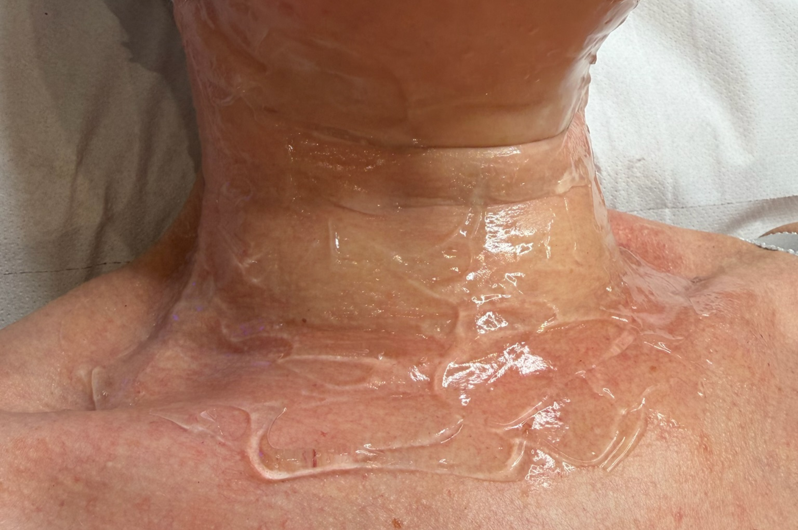 SKIN TIGHTENTING BEFORE