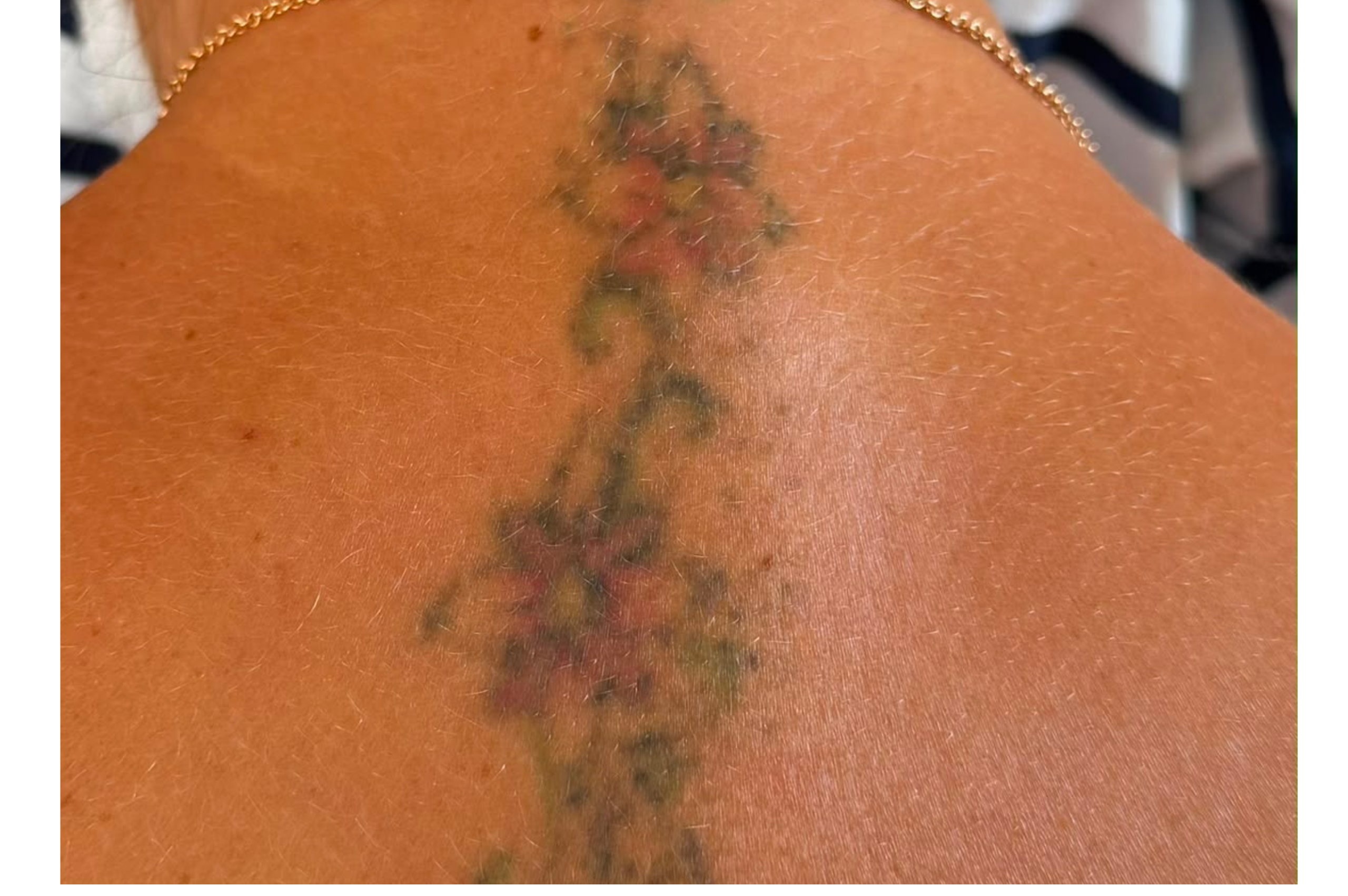 TATTOO REMOVAL AFTER