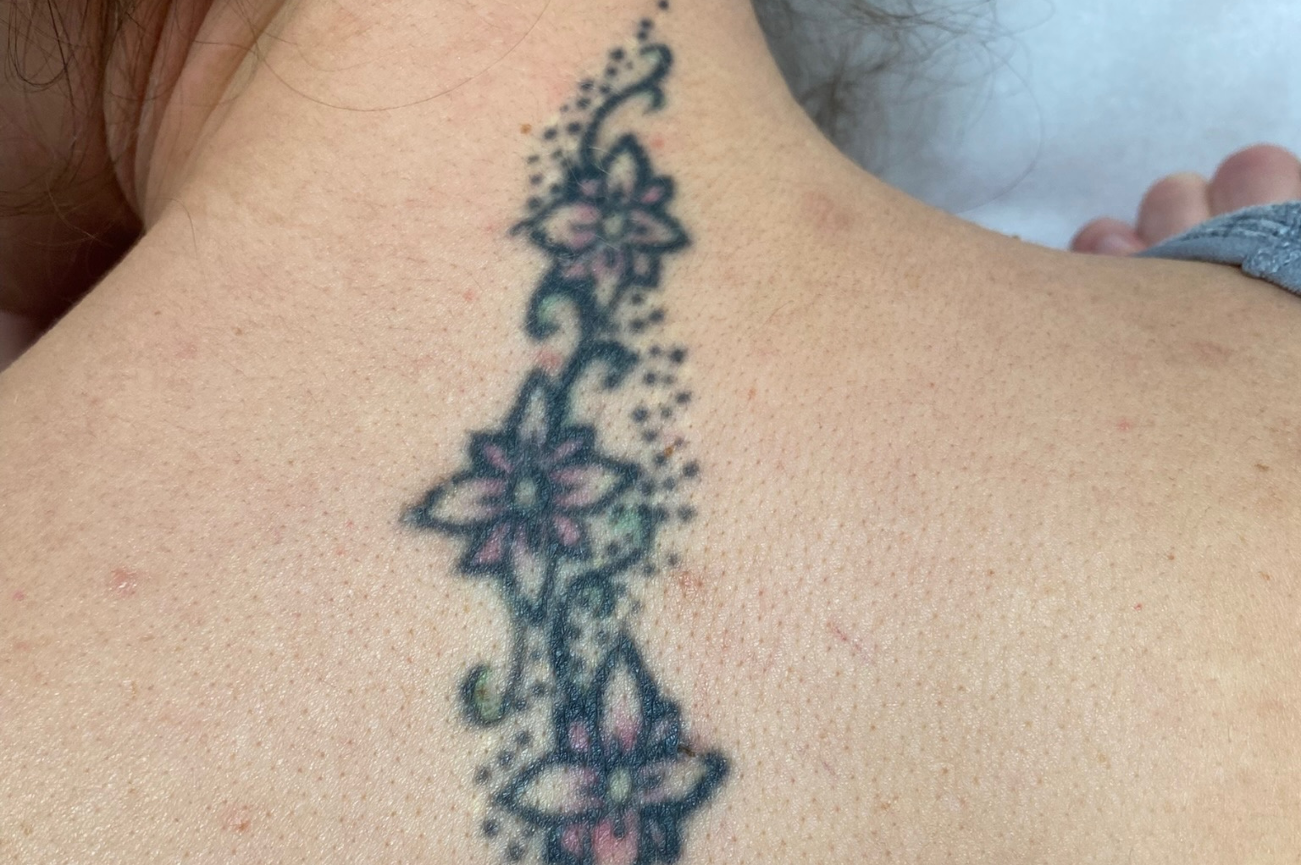 TATTOO REMOVAL BEFORE