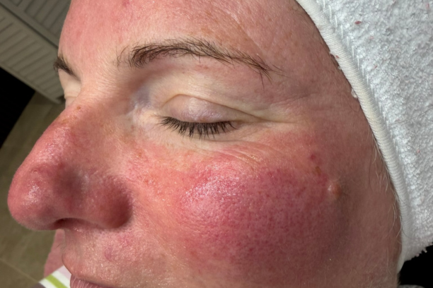 vascular lesion removal