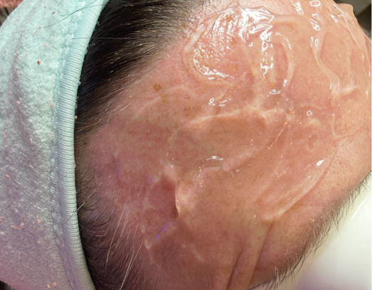 pigmentation removal
