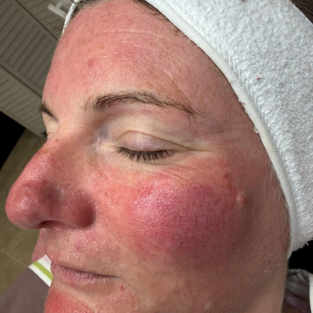 Vascular Lesion Removal